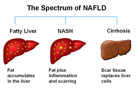 Diet Chart For Fatty Liver Disease