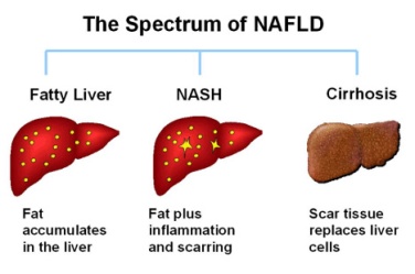 fatty liver disease diet plan with prediabetes